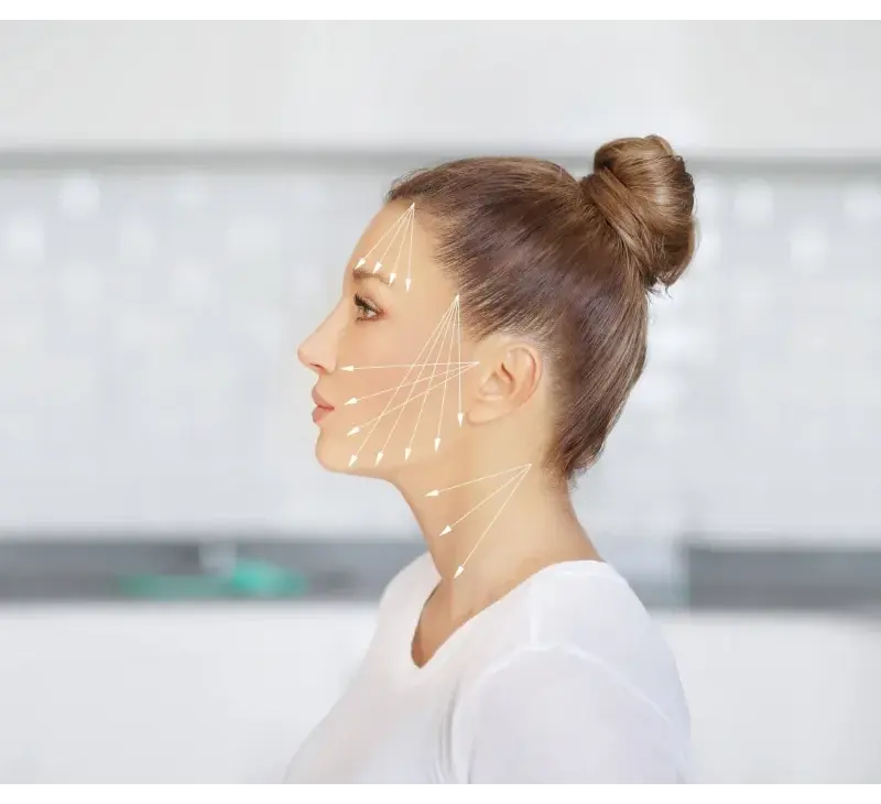 Collagen-Fadenlifting