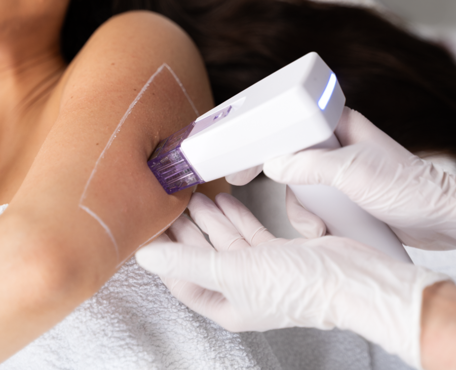 RF Needling Englisch